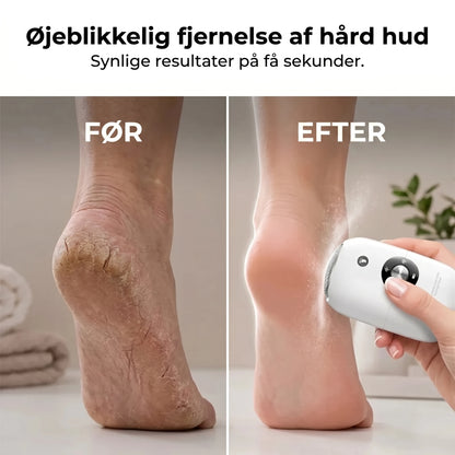 Elektrisk hårdhudsfjerner til fødder